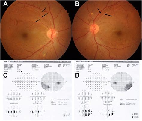 Glaucoma (Retinal Nerve Fiber Layer, RNFL) .